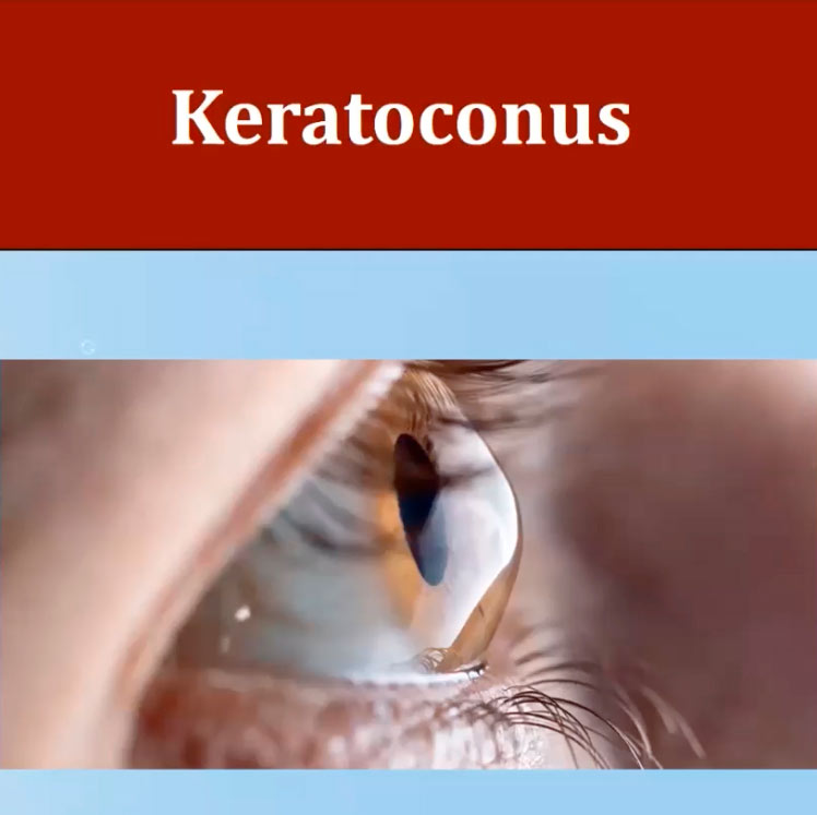 Keratoconus and Specialty Contact Lenses