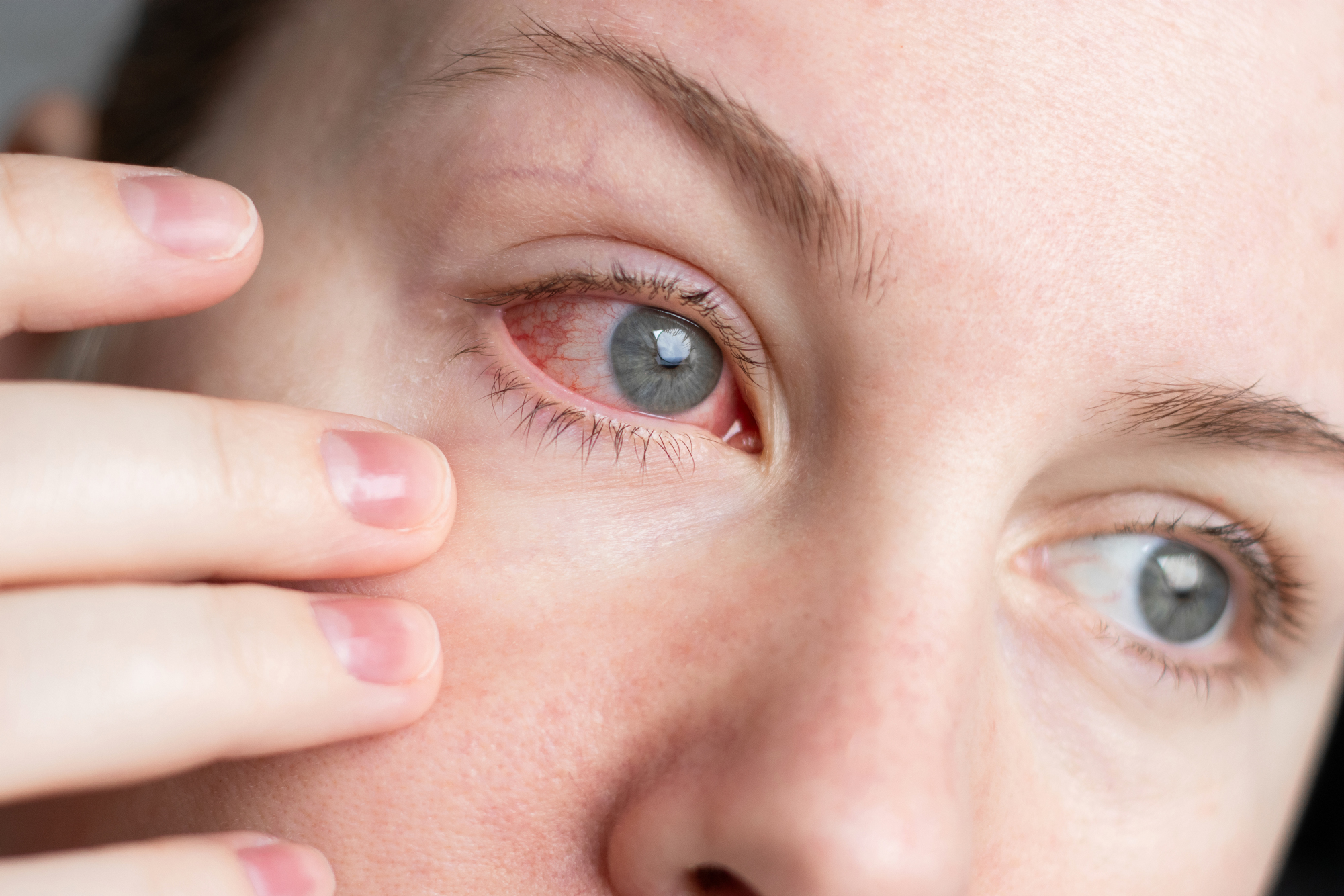 Dry Eye Disease